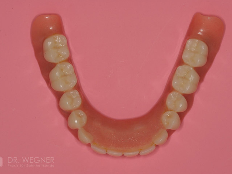 Verankerung Totalprothese