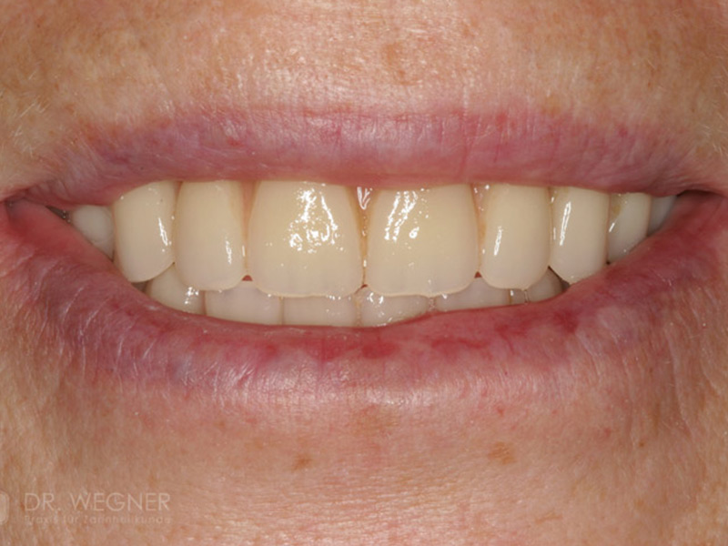 Verankerung Totalprothese