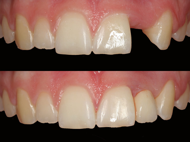 Adhäsivbrücke Fall 1