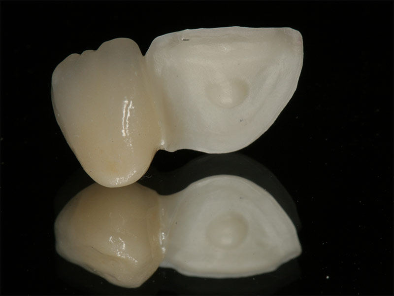 Adhäsivbrücke Fall 1