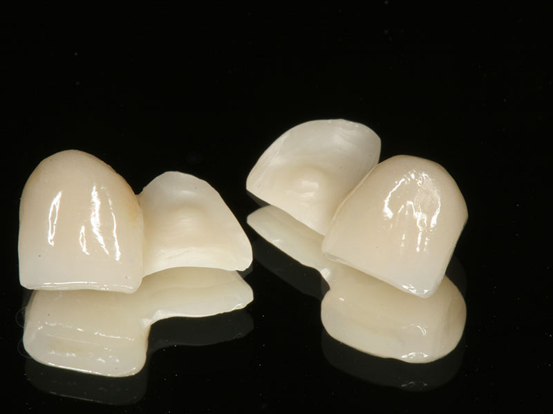 Adhäsivbrücke Fall 2