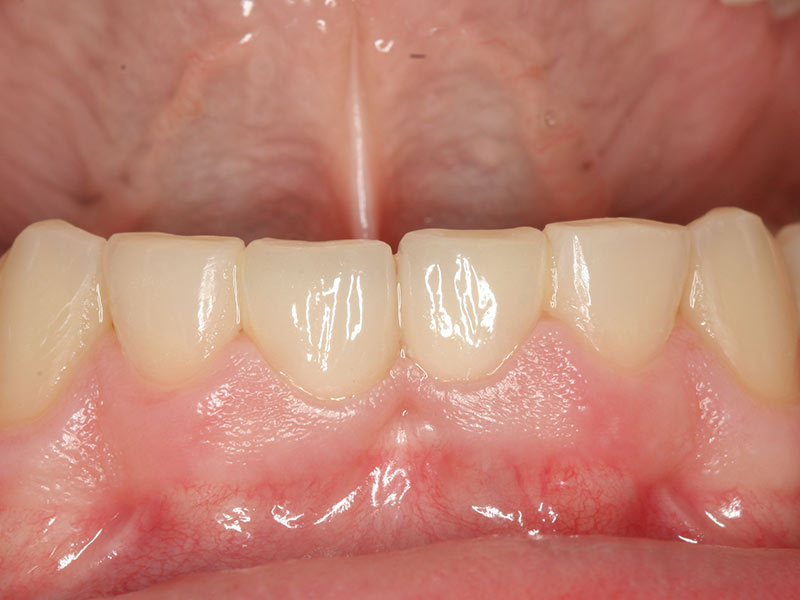 Adhäsivbrücke Fall 2