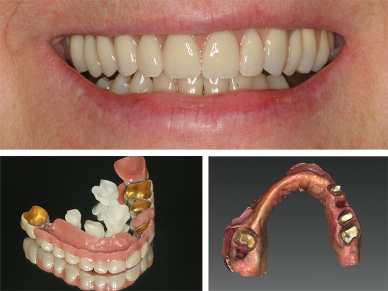 Gaumenplatte zahnersatz Zahnprothese: Teilprothese,