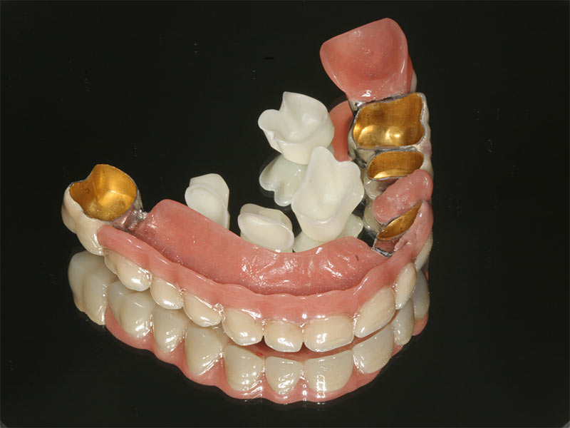 Teleskopkronenversorgung