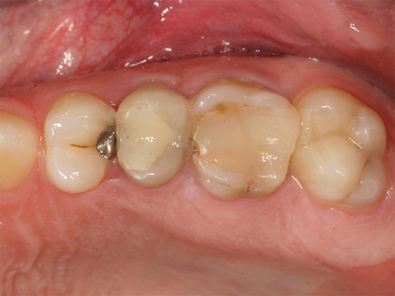 Vollkeramischer Zahnersatz