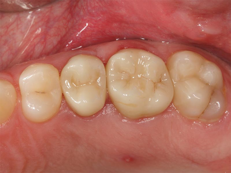 Vollkeramischer Zahnersatz