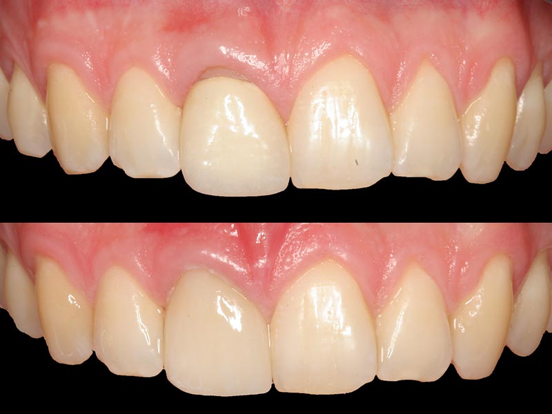 Vollkeramischer Zahnersatz