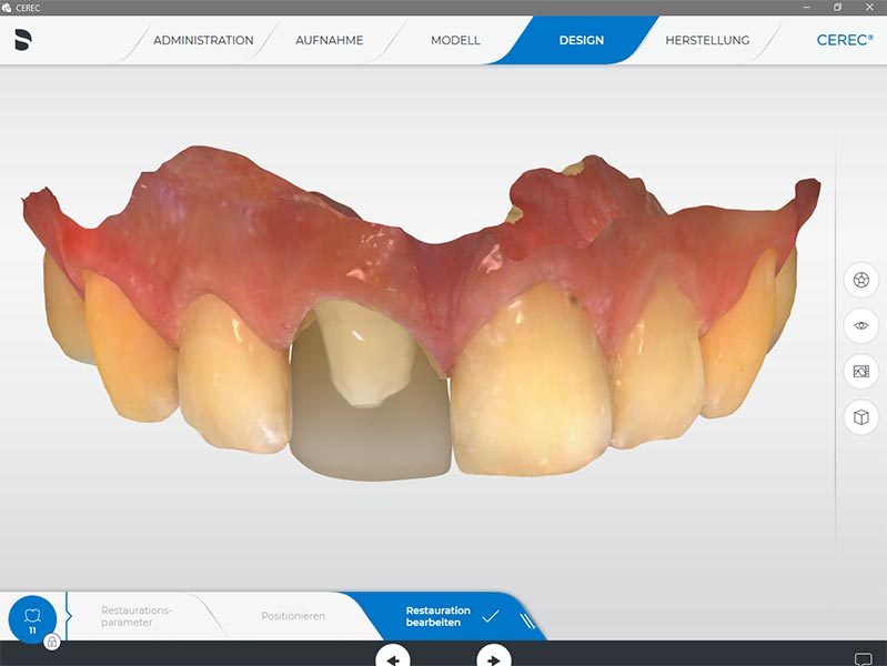 Vollkeramischer Zahnersatz