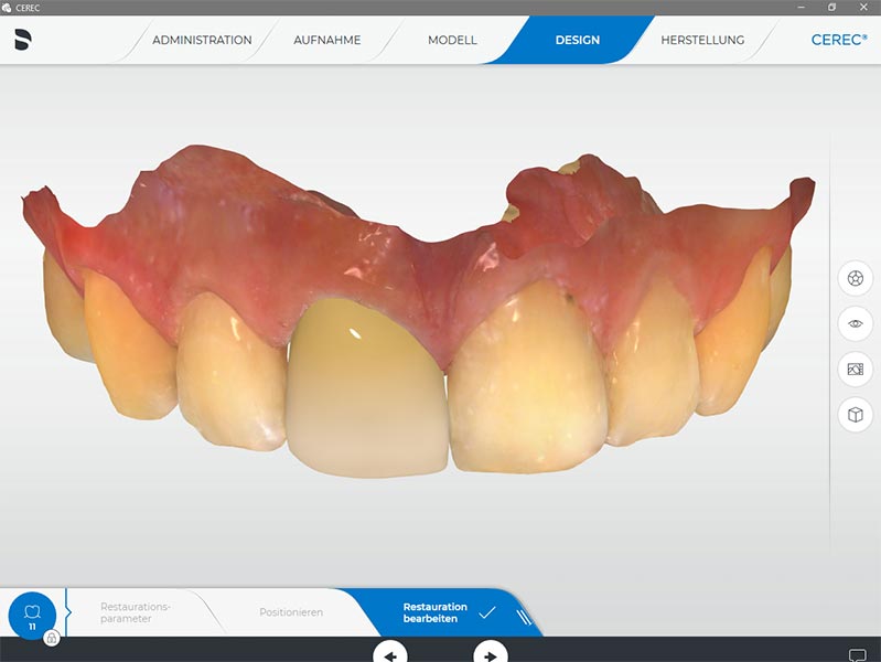 Vollkeramischer Zahnersatz