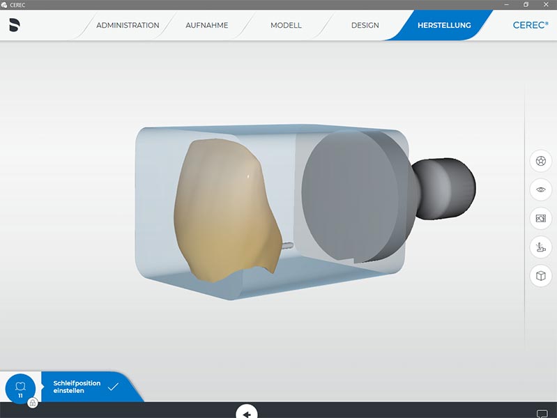 Vollkeramischer Zahnersatz