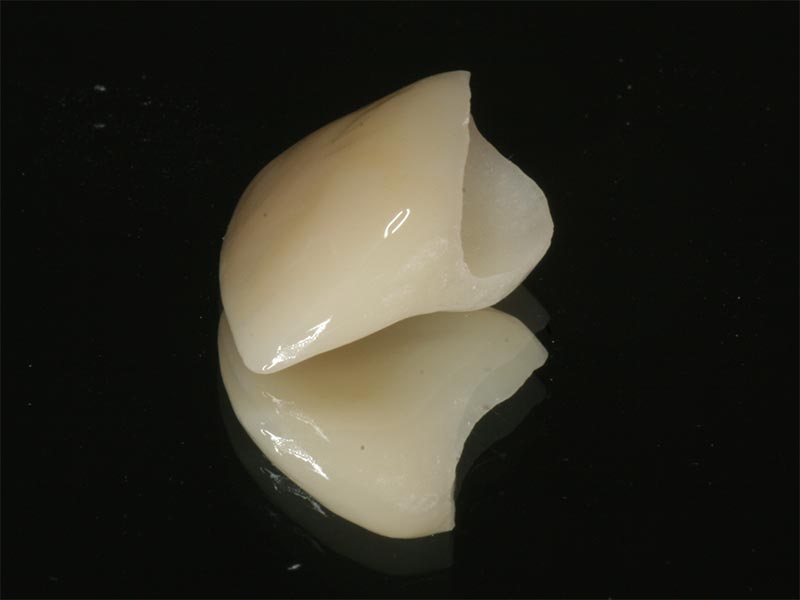 Vollkeramischer Zahnersatz