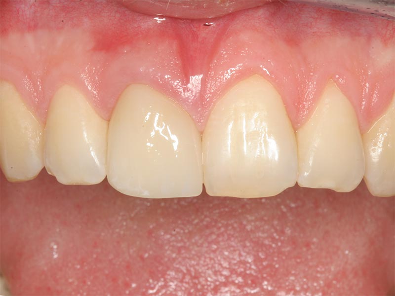 Vollkeramischer Zahnersatz